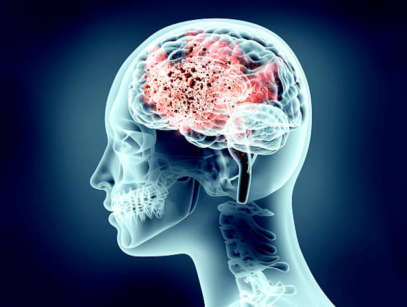 Clínica de Neuromodulação Transcraniana Não Invasiva Santa Tereza - Neuromodulação Cerebral